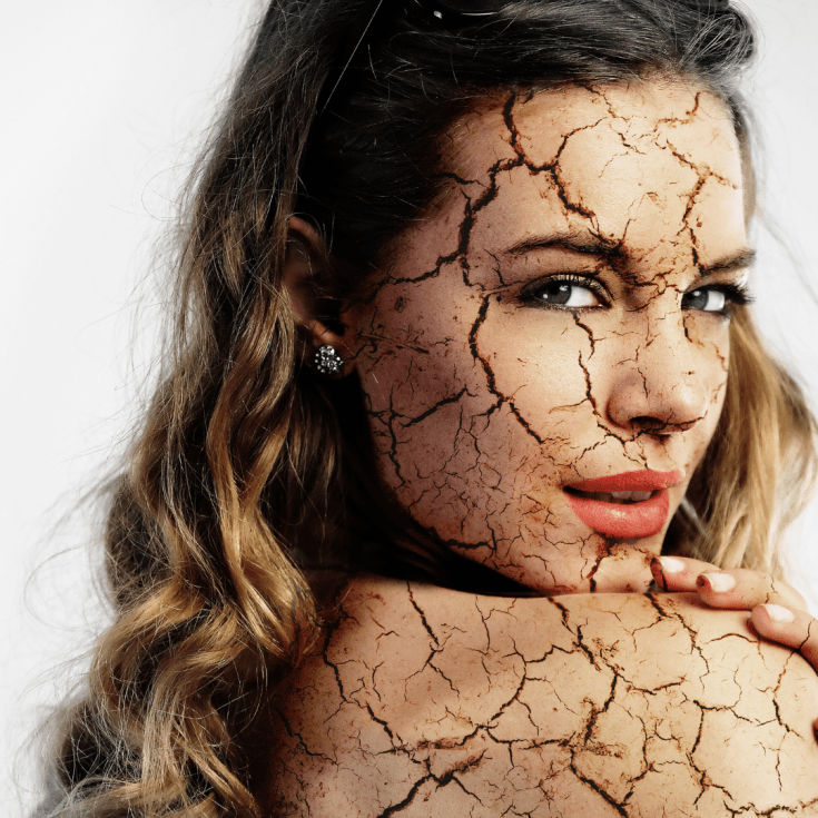 A pele pode ficar extremamente seca e sensível com o microbioma em desequilíbrio